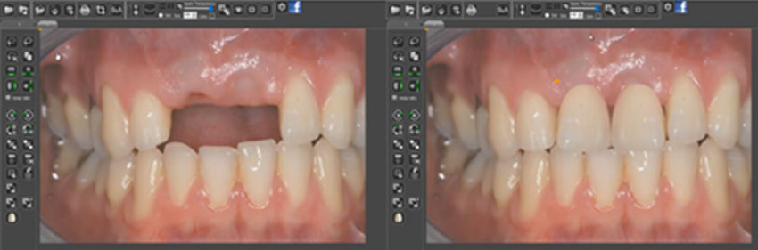 dental photo before and after treatment 2