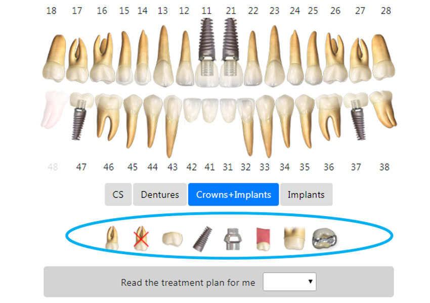 3D models of crowns and implants 1