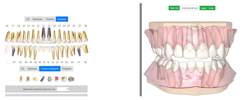 3D models of crowns and implants 3