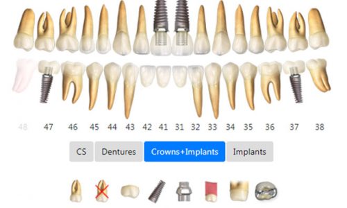 3D models of crowns and implants 2